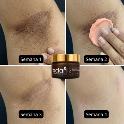 Aclari | Crema Despigmentante |