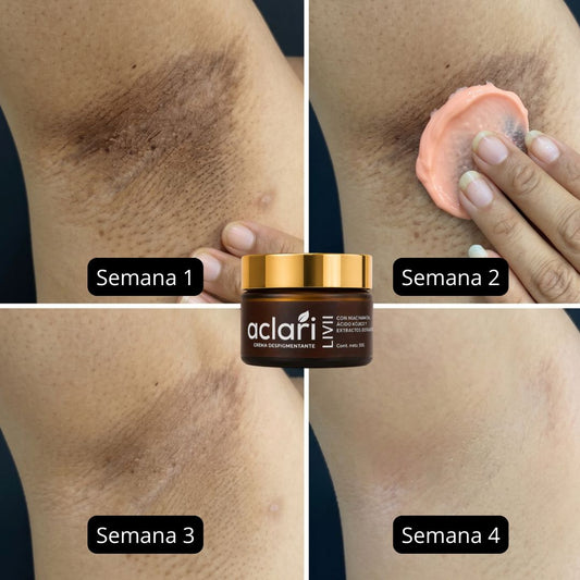 Aclari | Crema Despigmentante |